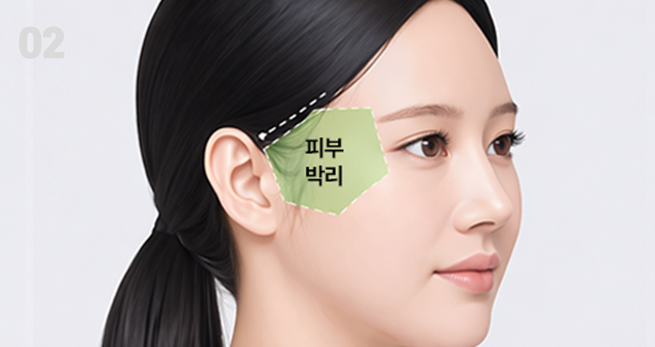 포니테일 리프팅 과정 02 - 개인별 절개 위치 및 리프팅 방향 계획