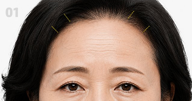 헤어라인 안쪽 최소 절개